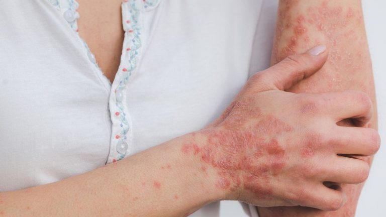Psoriasi, molto più che una malattia della pelle: come può influenzare la propria carriera